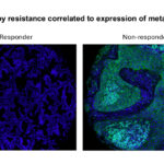 AI空間バイオマーカー技術で免疫療法の成功率向上 - 肺がんと皮膚がんの治療に大きな進展