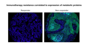 AI空間バイオマーカー技術で免疫療法の成功率向上 - 肺がんと皮膚がんの治療に大きな進展